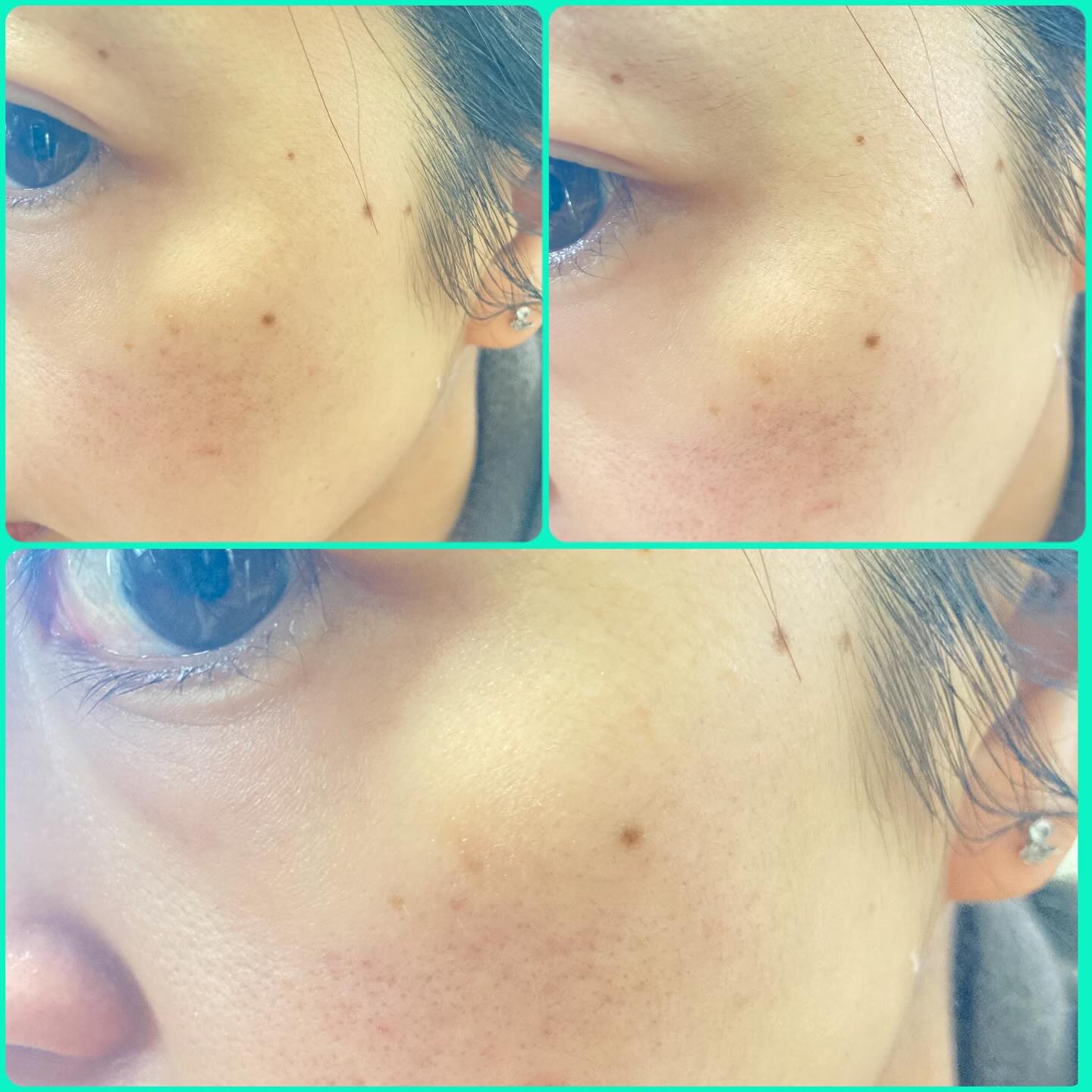 リスブラン マイルド エマルジョン/リスブラン/乳液を使ったクチコミ（3枚目）