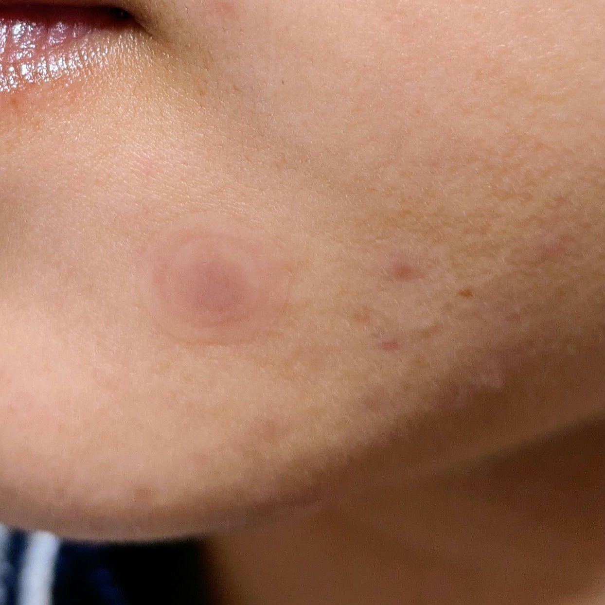 ゼロスポットパッチCICA/Today’s Cosme/その他スキンケアを使ったクチコミ（3枚目）