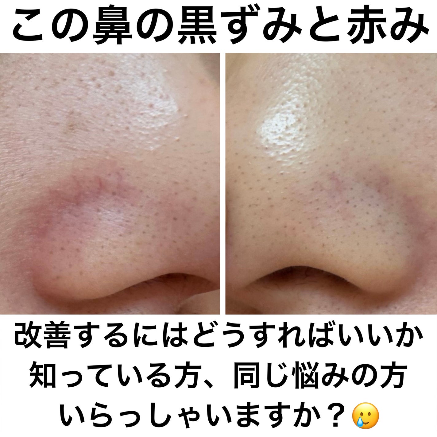 もぐもぐ on LIPS 「鼻の黒ずみと赤みの悩みがある人集合ー‼️/最近鼻の赤みと黒ずみ..」(1枚目)