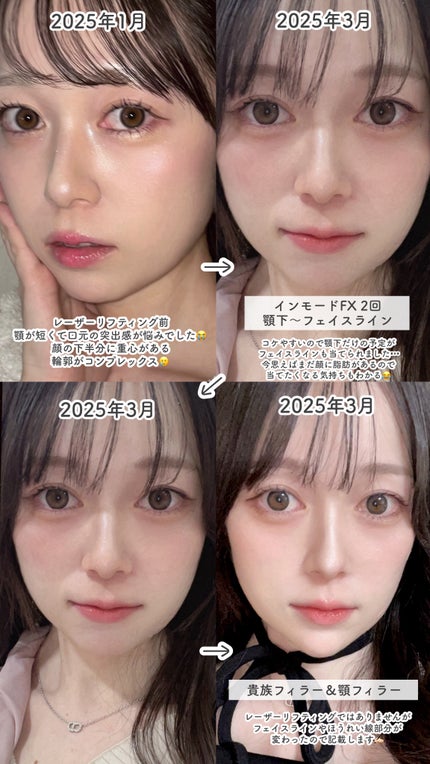 tobibi on LIPS 「顔の下半身を垢抜けさせるためにやった/レーザーリフティング施術..」(2枚目)