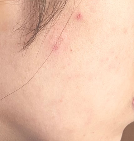 ACマグネシウムパッチ/スノーツープラス/シートマスク・パックを使ったクチコミ(5枚目)