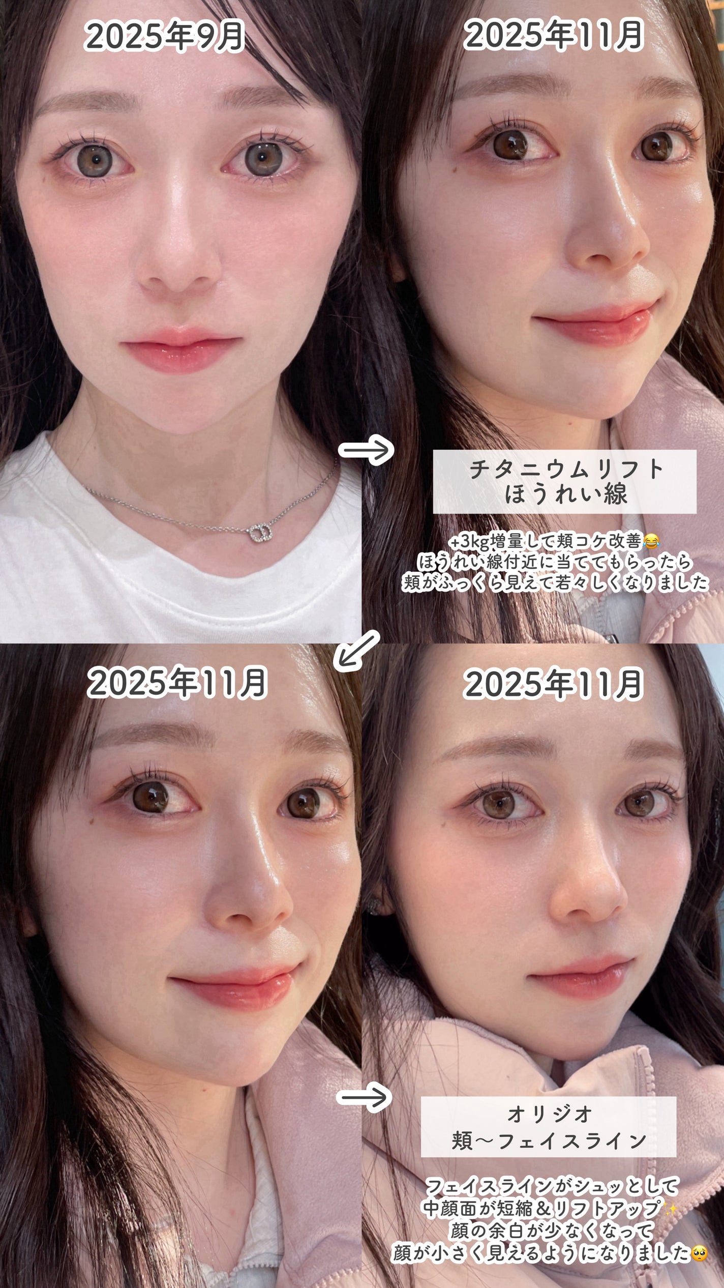 tobibi on LIPS 「顔の下半身を垢抜けさせるためにやった/レーザーリフティング施術..」(4枚目)