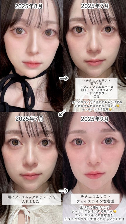 tobibi on LIPS 「顔の下半身を垢抜けさせるためにやった/レーザーリフティング施術..」(3枚目)