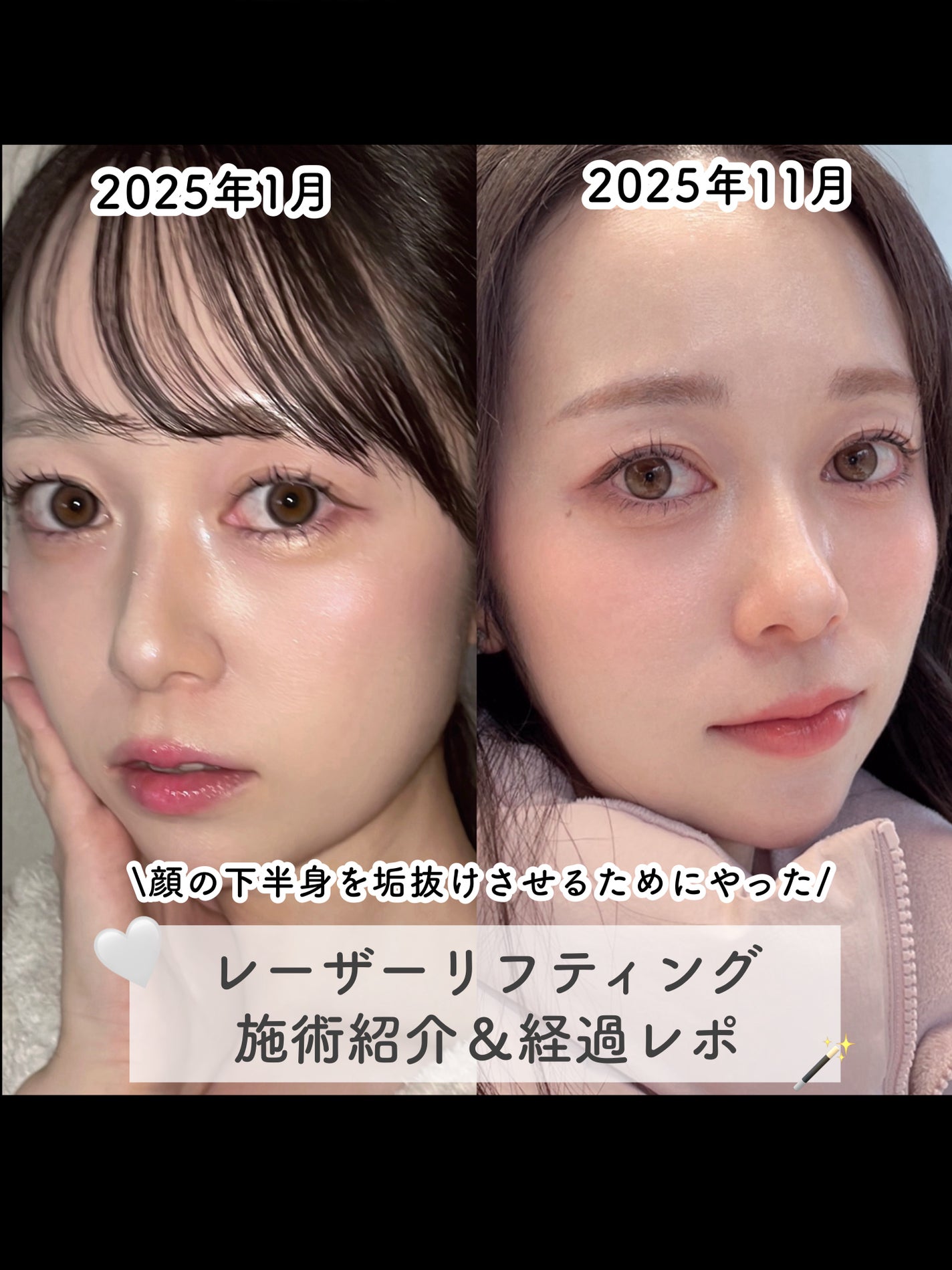 tobibi on LIPS 「顔の下半身を垢抜けさせるためにやった/レーザーリフティング施術..」(1枚目)