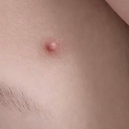 ACマグネシウムパッチ/スノーツープラス/シートマスク・パックを使ったクチコミ(2枚目)