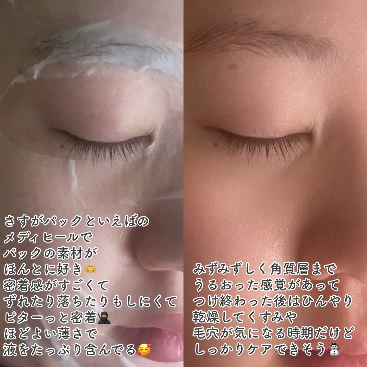 PDRN リフティングマスク/MEDIHEAL/シートマスク・パックを使ったクチコミ（3枚目）