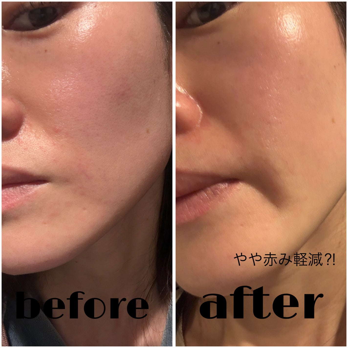 トラブルパッチマスク/EIOM/その他スキンケアを使ったクチコミ(6枚目)