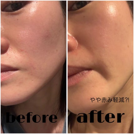 トラブルパッチマスク/EIOM/その他スキンケアを使ったクチコミ(6枚目)