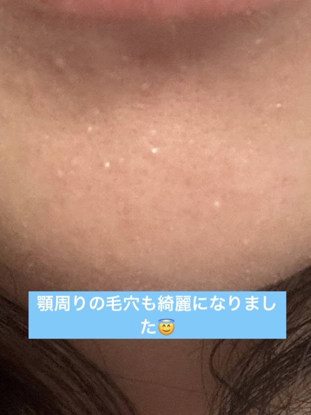 ホットクレンジングゲル マッサージプラス 使い切り６包/マナラ/クレンジングジェルを使ったクチコミ（3枚目）