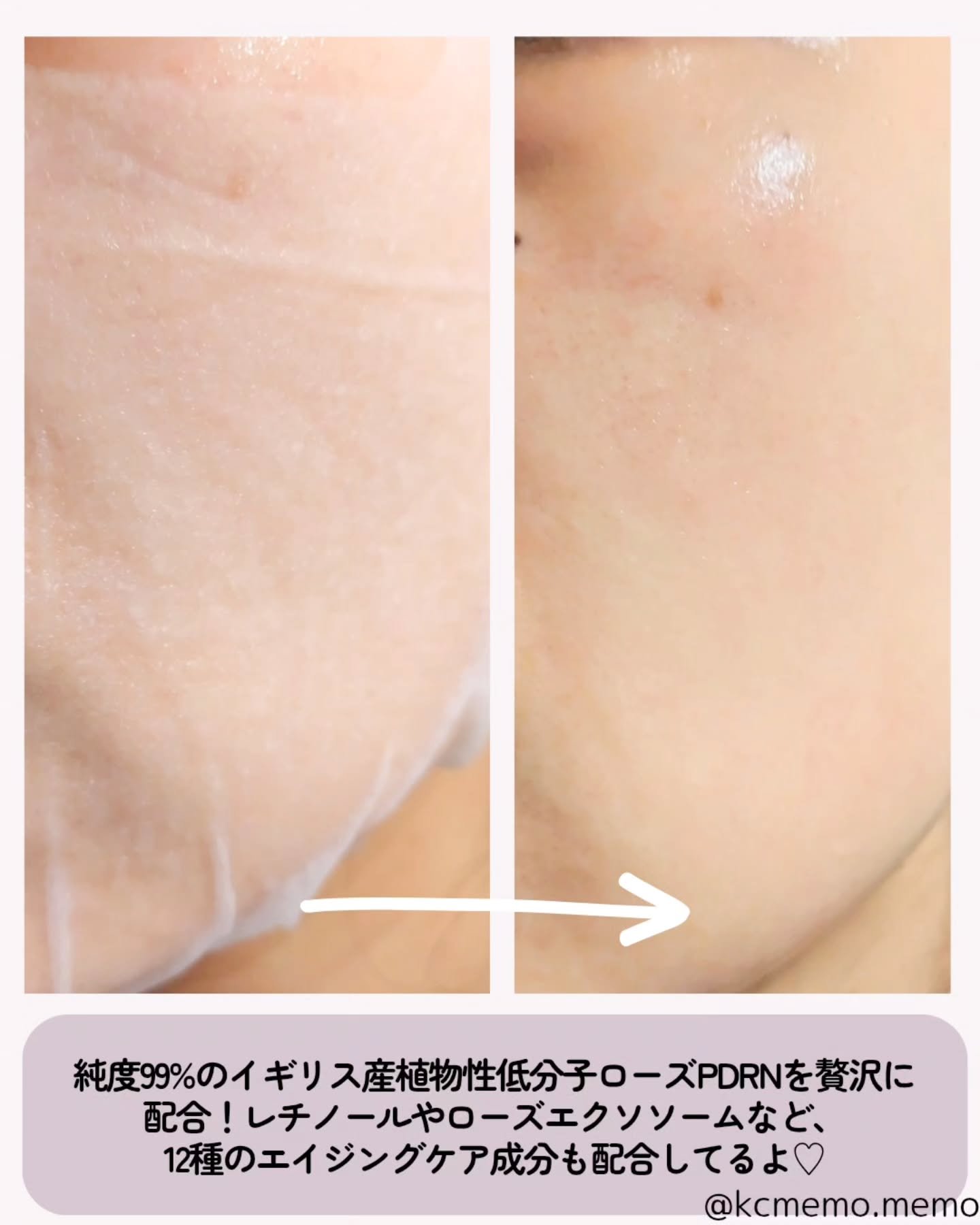 PDRN リフティングマスク/MEDIHEAL/シートマスク・パックを使ったクチコミ（3枚目）