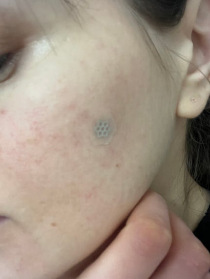 ACマグネシウムパッチ/スノーツープラス/シートマスク・パックを使ったクチコミ(2枚目)