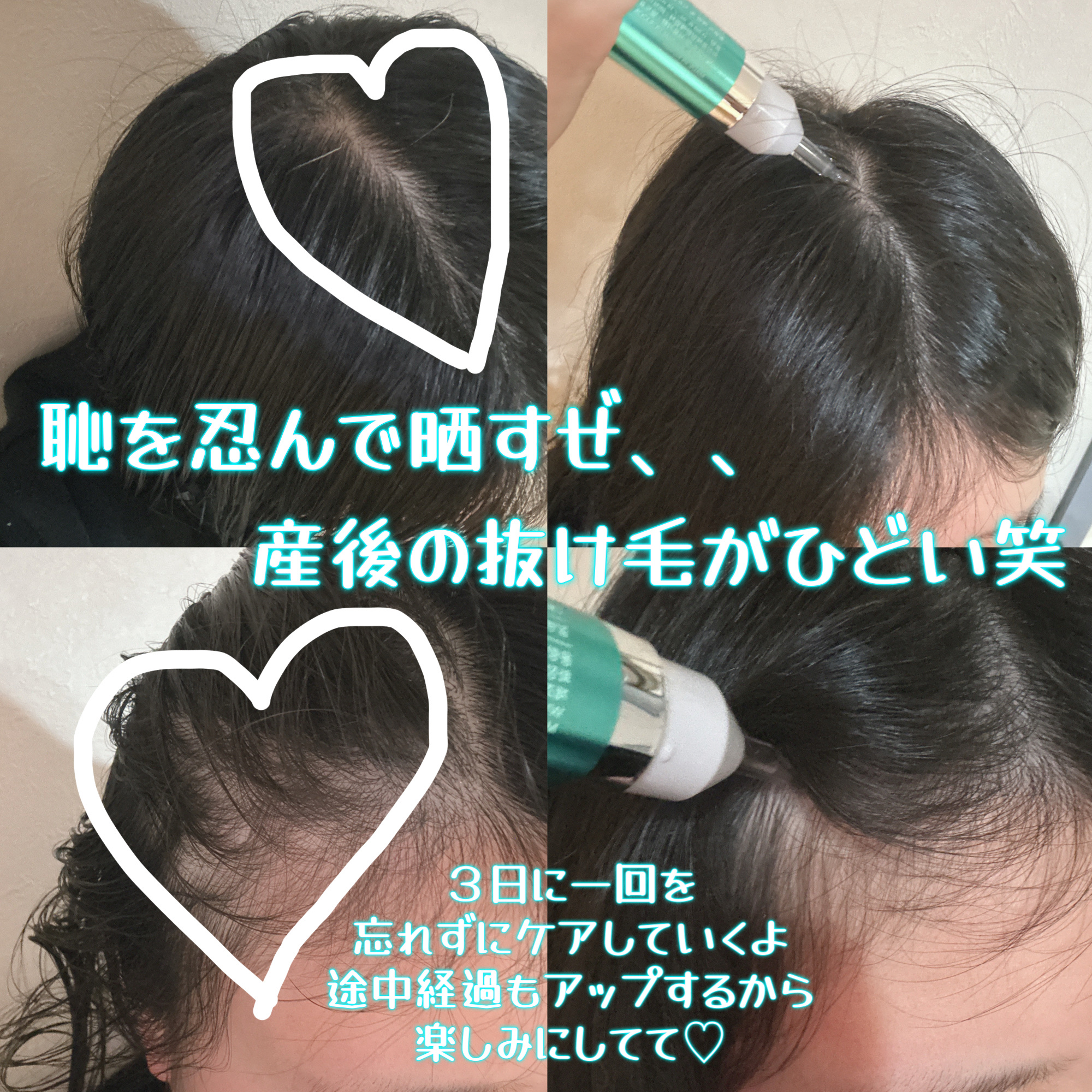 PDRNヘアアンプル300/VT/頭皮ローションを使ったクチコミ（3枚目）
