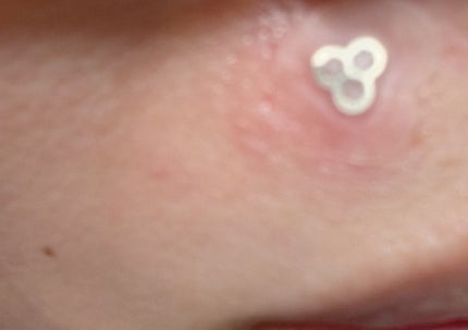 ACマグネシウムパッチ/スノーツープラス/シートマスク・パックを使ったクチコミ(4枚目)