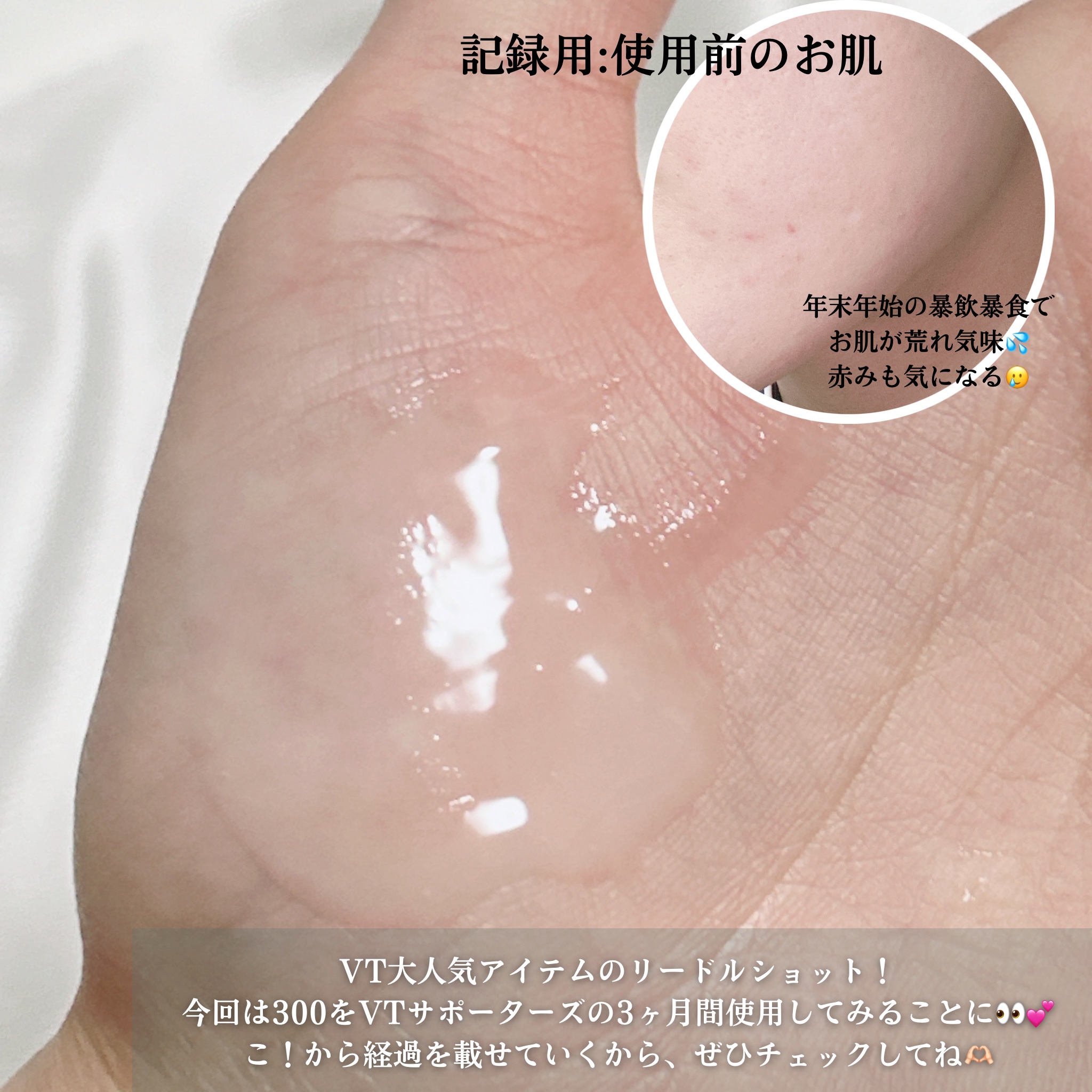 リードルショット300/VT/美容液を使ったクチコミ（2枚目）