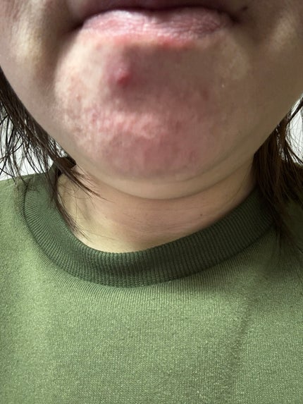 ACマグネシウムパッチ/スノーツープラス/シートマスク・パックを使ったクチコミ(5枚目)