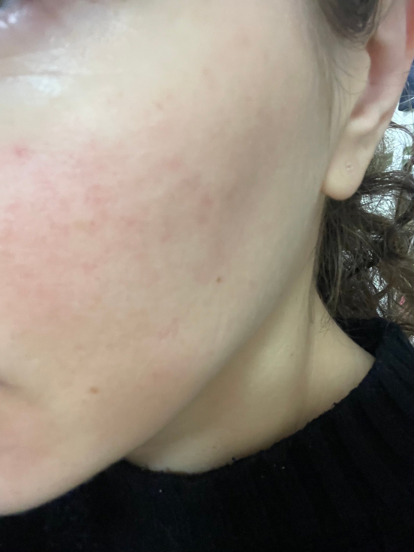 ACマグネシウムパッチ/スノーツープラス/シートマスク・パックを使ったクチコミ(1枚目)