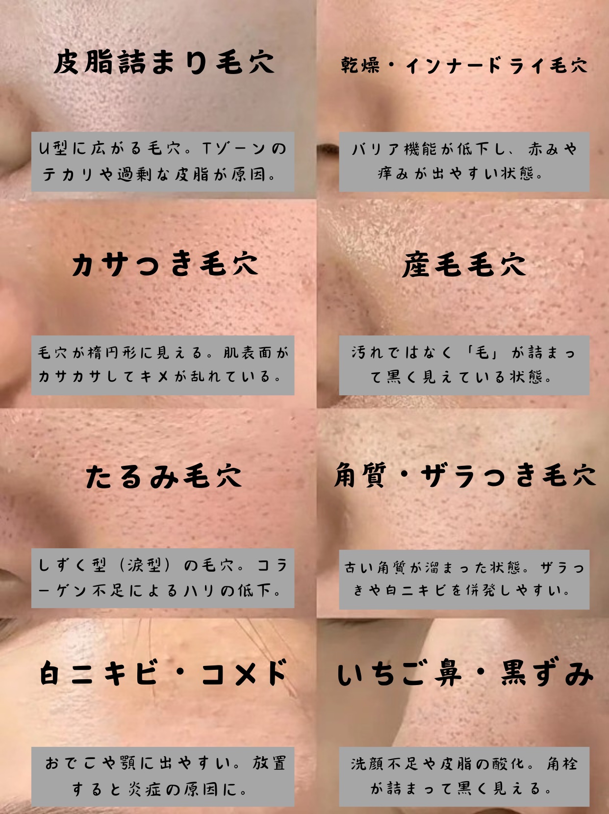 アネトス アクネケア トリートメント セラム/Anetos/美容液を使ったクチコミ（2枚目）