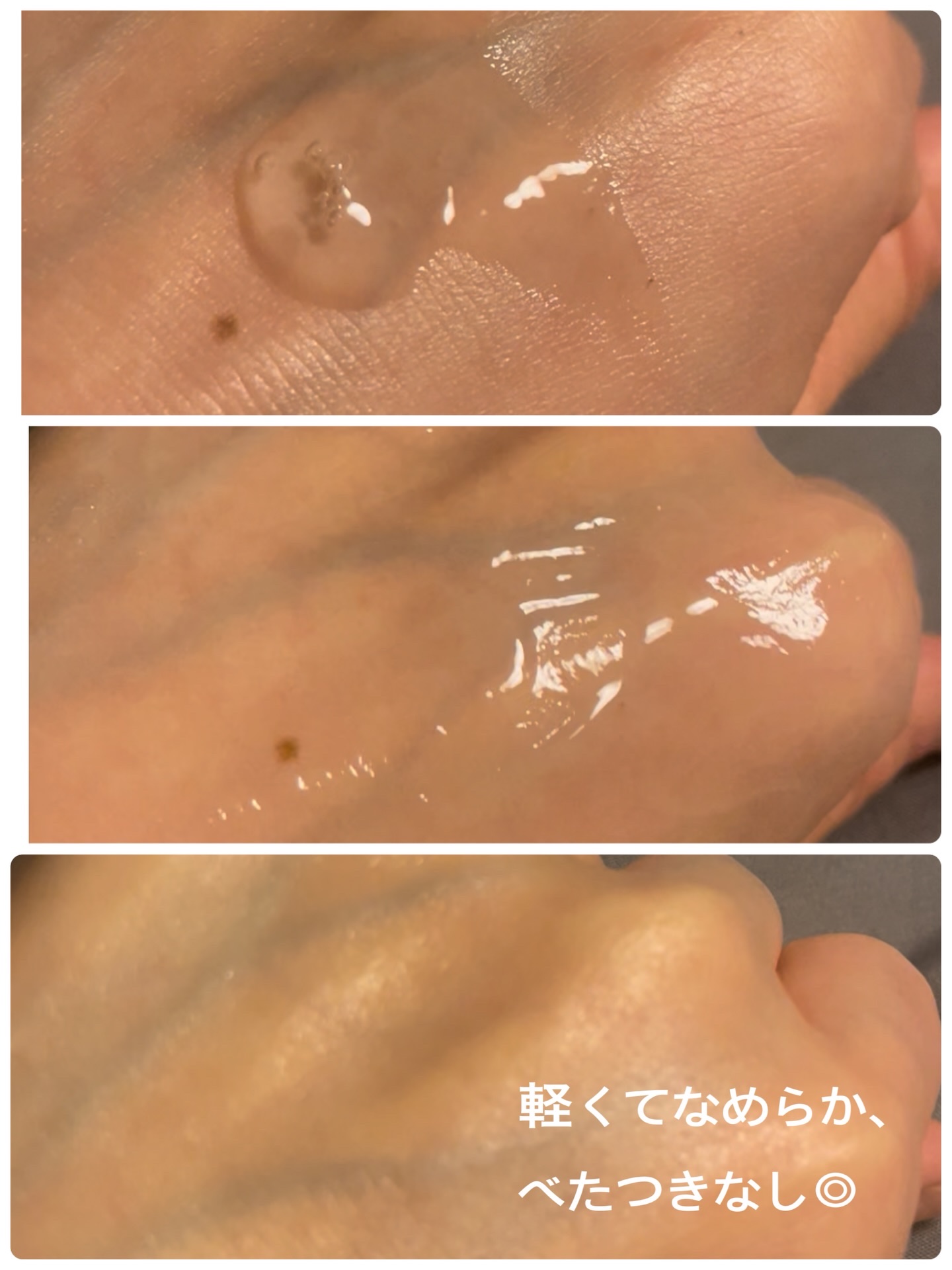 アネトス アクネケア トリートメント セラム/Anetos/美容液を使ったクチコミ（3枚目）