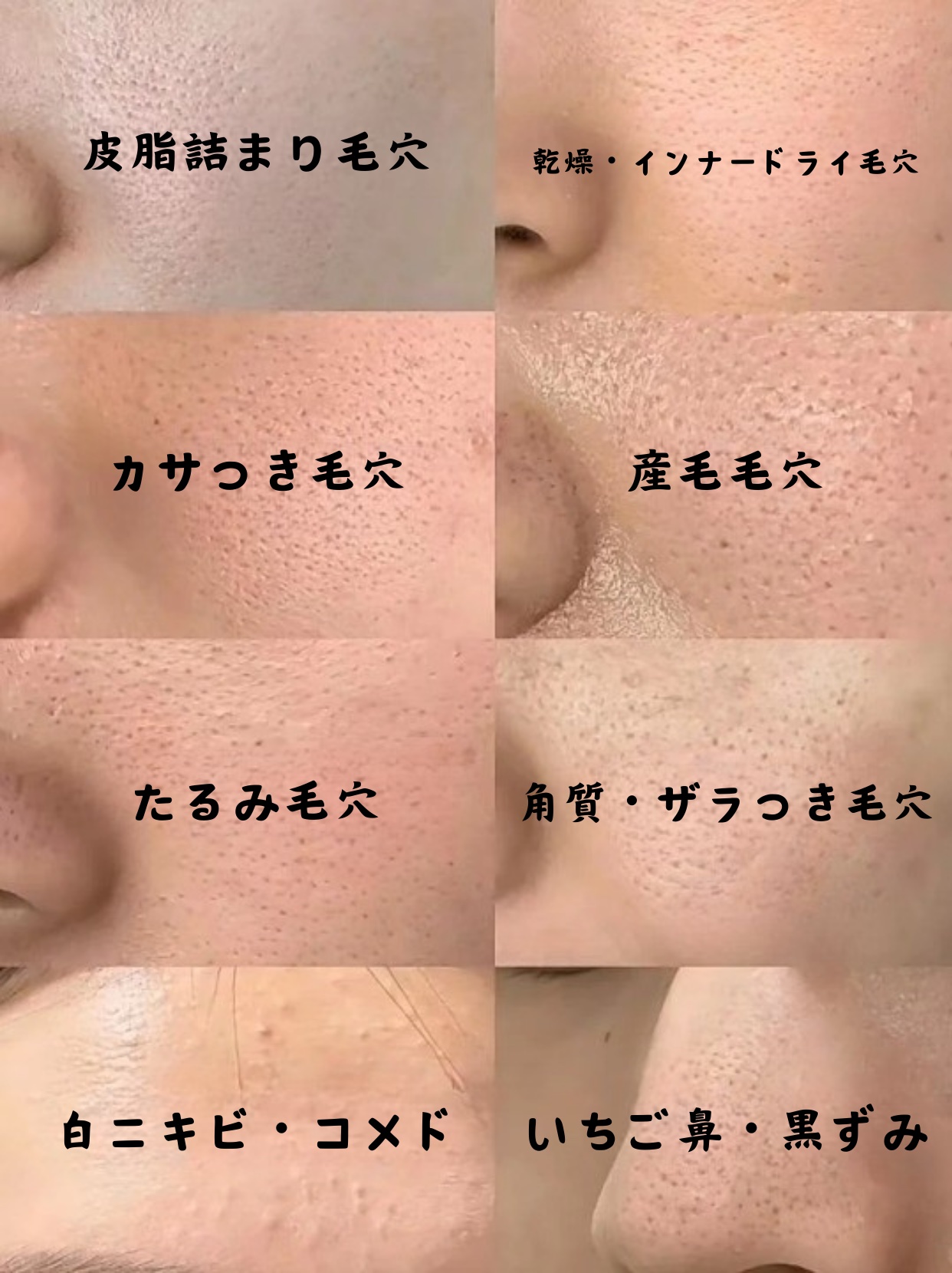 アネトス アクネケア トリートメント セラム/Anetos/美容液を使ったクチコミ（1枚目）