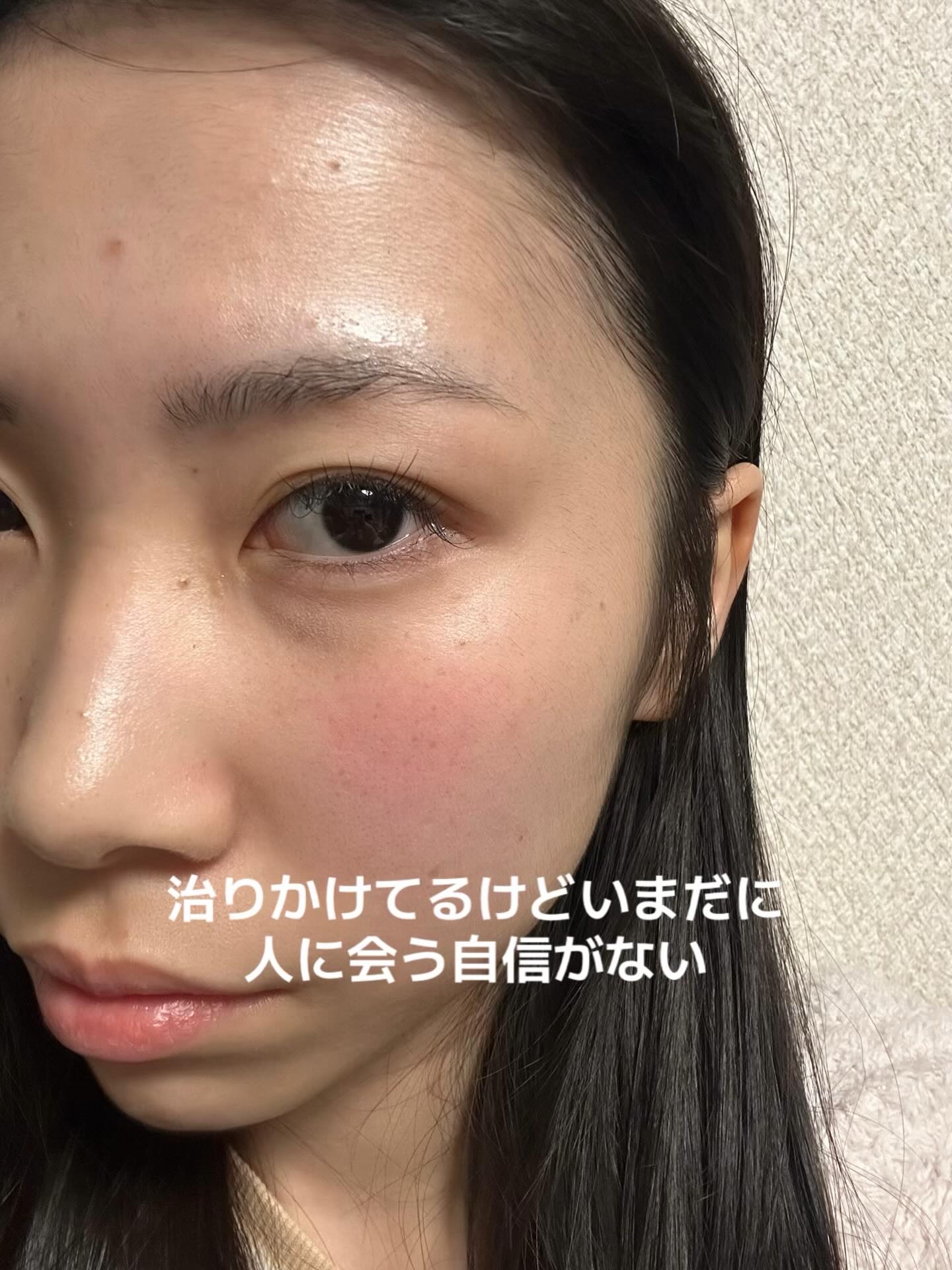 345リリーフクリーム/Dr.Althea/フェイスクリームを使ったクチコミ（2枚目）