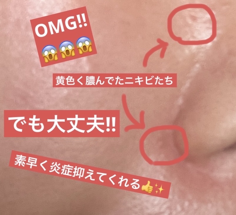 メンソレータム アクネス25 メディカルクリームEXa(医薬品)/メンソレータム アクネス25/その他を使ったクチコミ（3枚目）