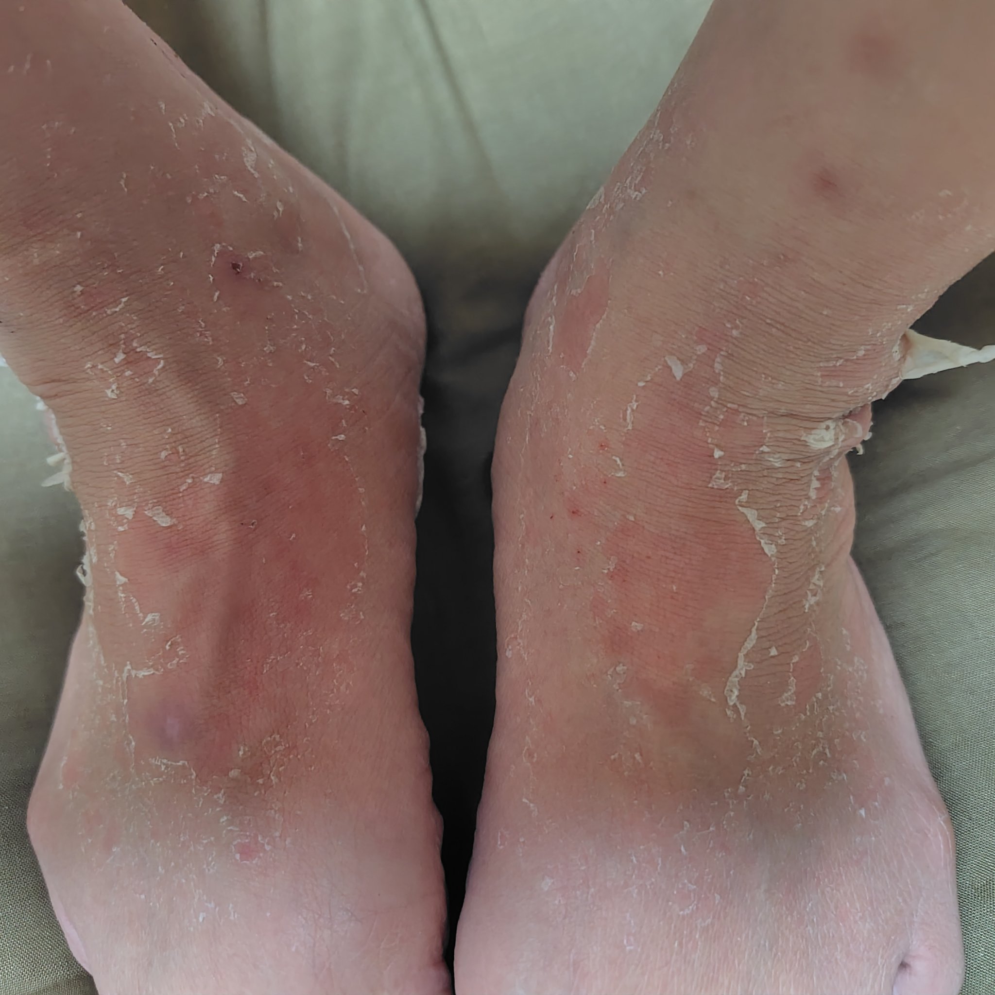 イージーパックDP60分タイプ/ベビーフット/レッグ・フットケアを使ったクチコミ（3枚目）