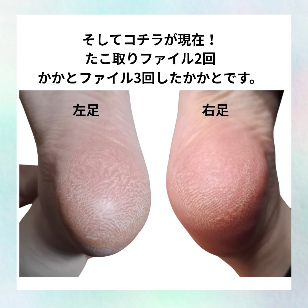 デュアルアクション たこ取りファイル/メディキュット/ボディグッズを使ったクチコミ（3枚目）