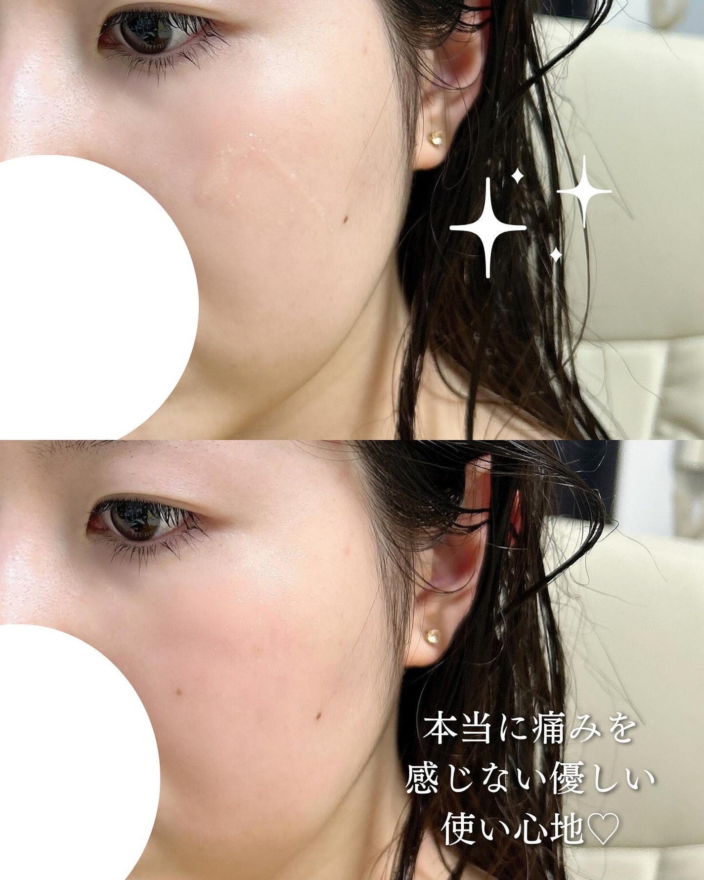 マイクロダーマブースター/XOUL/美容液を使ったクチコミ(4枚目)