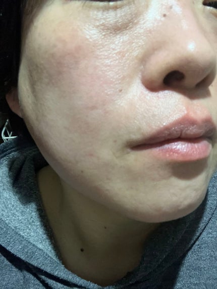 ディープビタCアンプル/MEDICUBE/美容液を使ったクチコミ(7枚目)