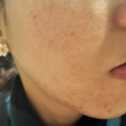 miina@汚肌工事録⚠️ on LIPS 「2023/06/25の#汚肌工事録次の日は#血みどろピーリング..」(1枚目)