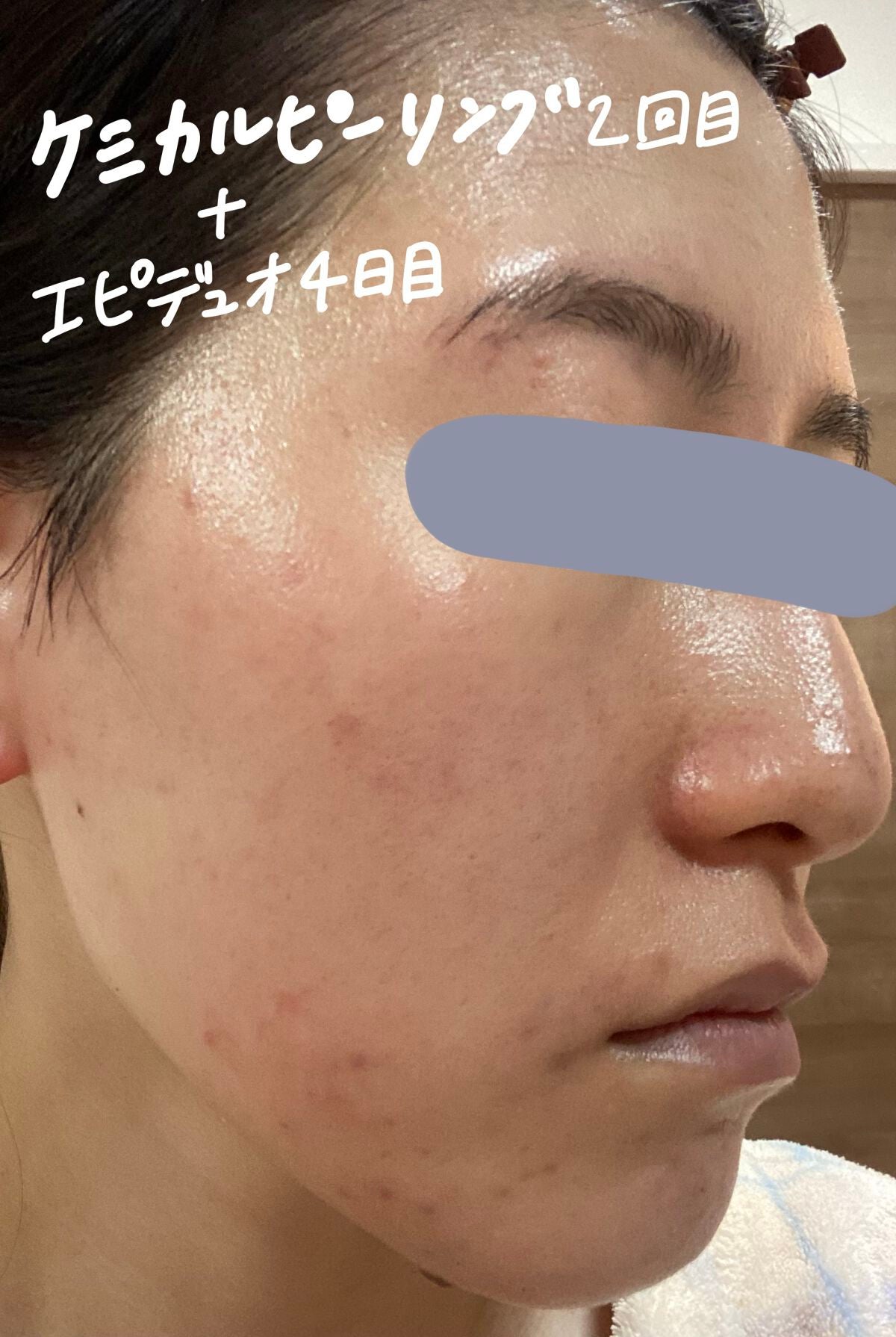 スキンピールバー ティートゥリー/サンソリット/洗顔石鹸を使ったクチコミ(3枚目)