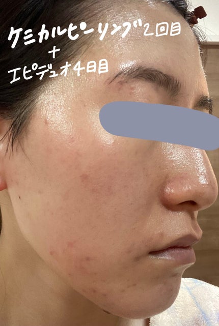 スキンピールバー ティートゥリー/サンソリット/洗顔石鹸を使ったクチコミ(3枚目)