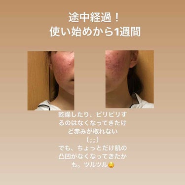 ここみ on LIPS 「ニキビの治療を初めてから、約1週間！途中経過を載せておきます使..」（2枚目）