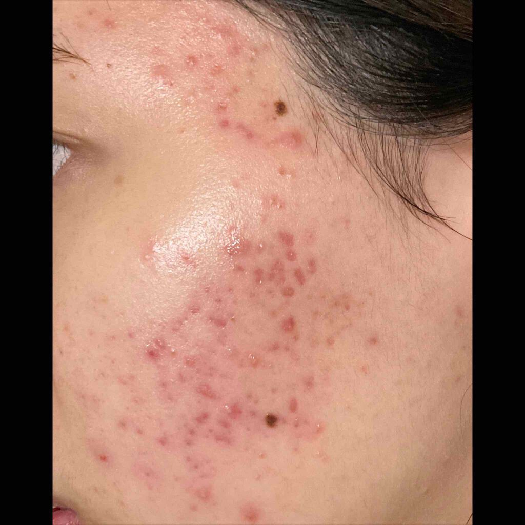 ハトムギ化粧水(ナチュリエ スキンコンディショナー R )/ナチュリエ/化粧水を使ったクチコミ（1枚目）