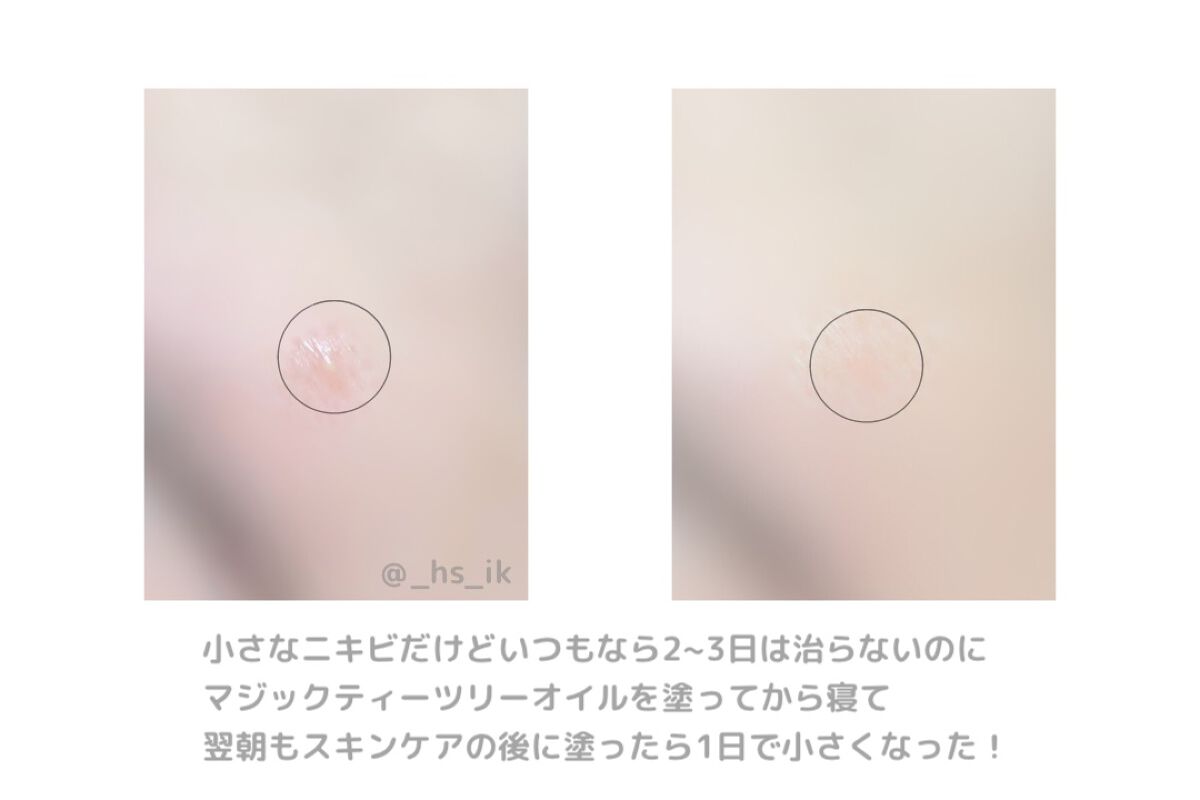 マジックティーツリーオイル/ブラン/フェイスオイルを使ったクチコミ(2枚目)