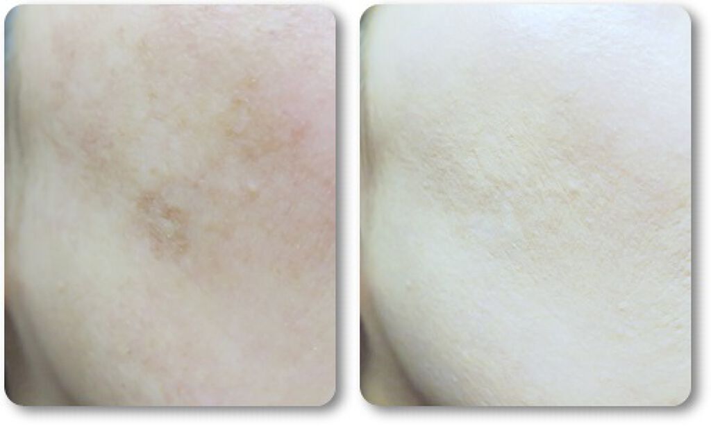 アルーチェルーチェ クッションファンデーション/Aluce luce/クッションファンデーションを使ったクチコミ(2枚目)