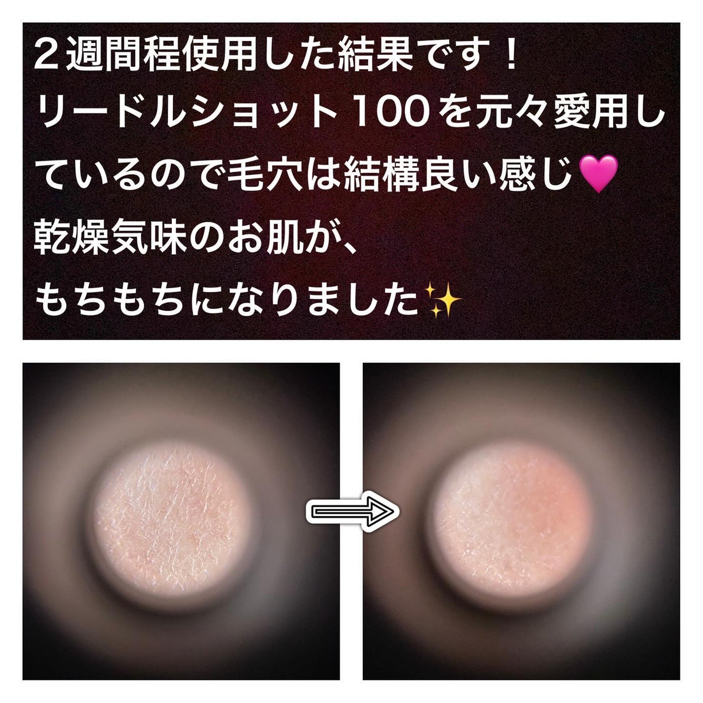 プロCICAリードルショット100/VT/ブースター・導入液を使ったクチコミ(6枚目)