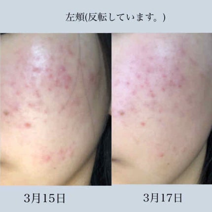 バイオイル/バイオイル/フェイスオイルを使ったクチコミ(3枚目)