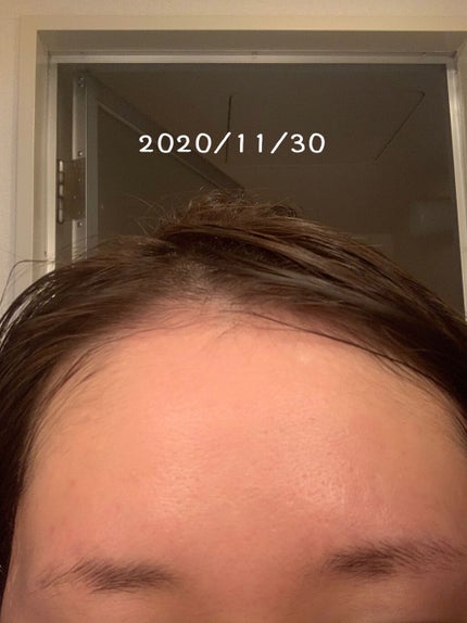 まめ on LIPS 「2020.1〜2020.11までの肌事情。25歳を迎えてからニ..」(5枚目)