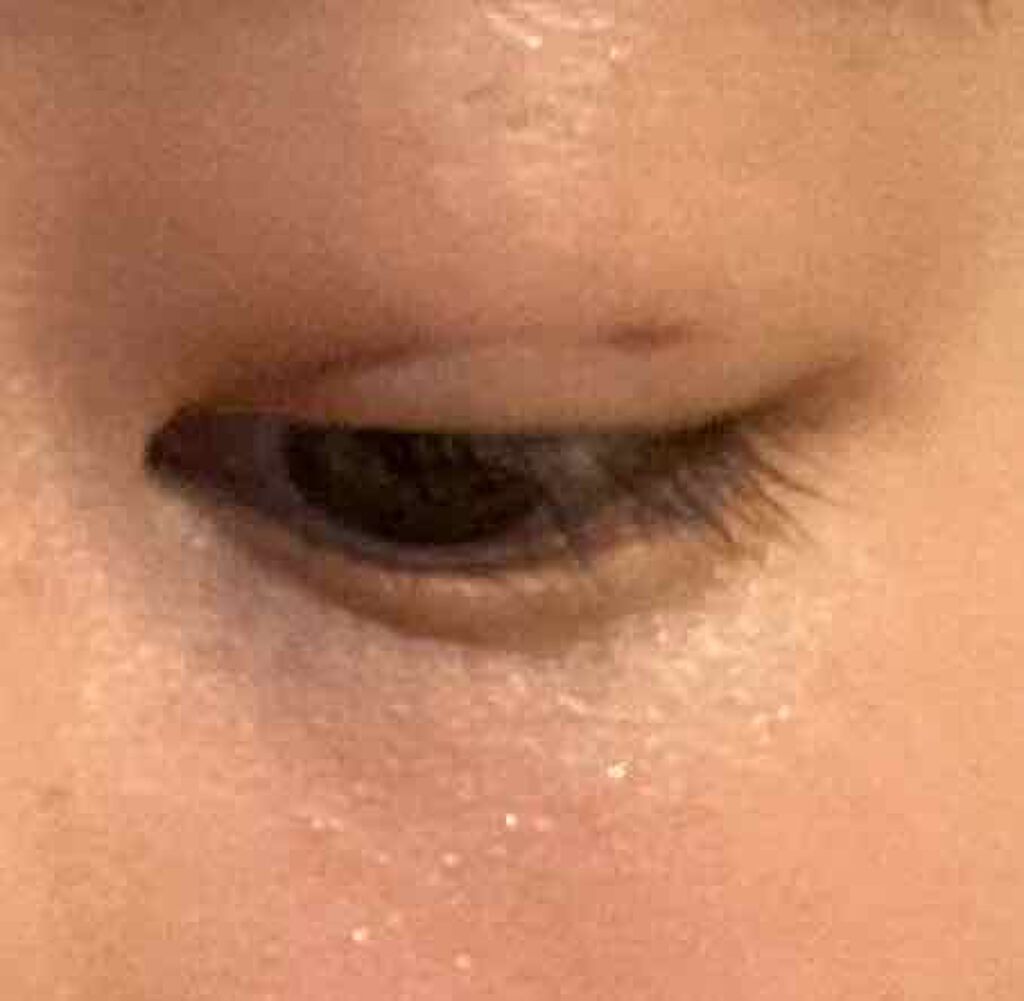 さな on LIPS 「痛みが完全に消えた、7日目!顔洗ったばっかりだからなんかテカテ..」(2枚目)