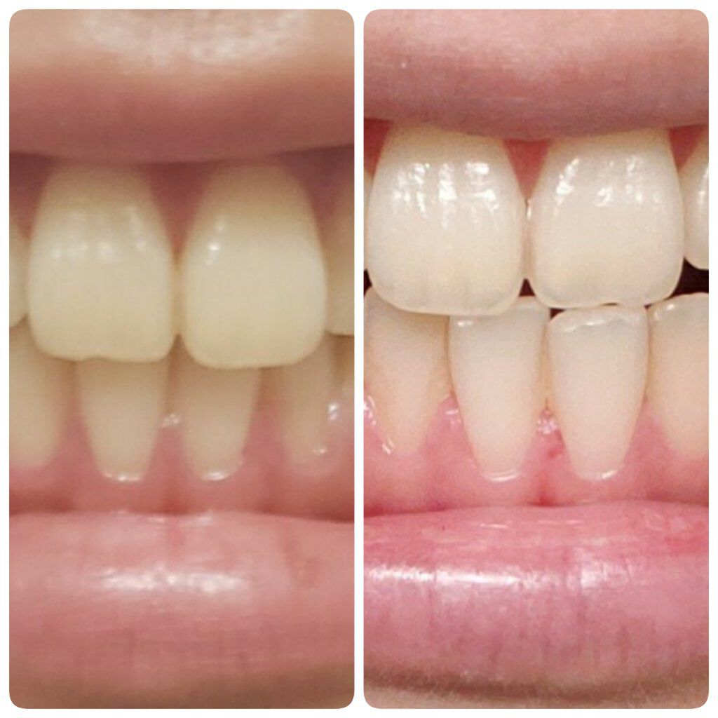 アパガードプレミオ/アパガード/歯磨き粉を使ったクチコミ（1枚目）