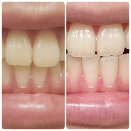 アパガードプレミオ/アパガード/歯磨き粉を使ったクチコミ(1枚目)