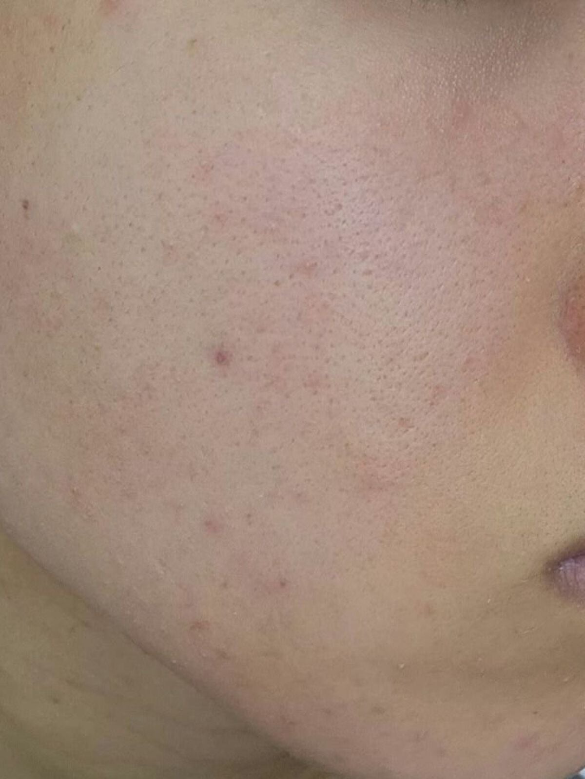 レチノールA 1% アドバンスドリバイタリゼーションクリーム/Life-flo/フェイスクリームを使ったクチコミ(5枚目)