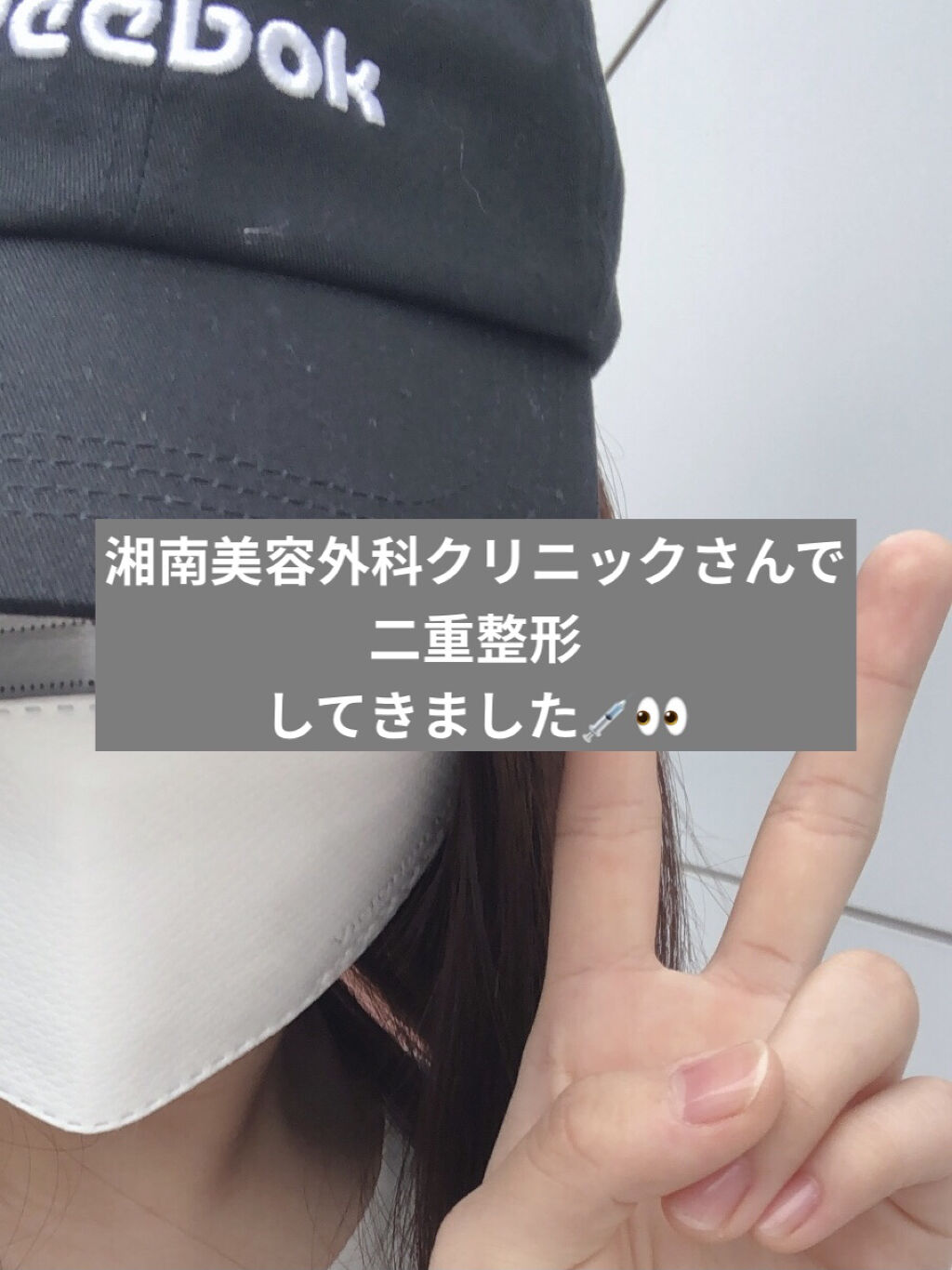 二重整形/その他を使ったクチコミ（1枚目）
