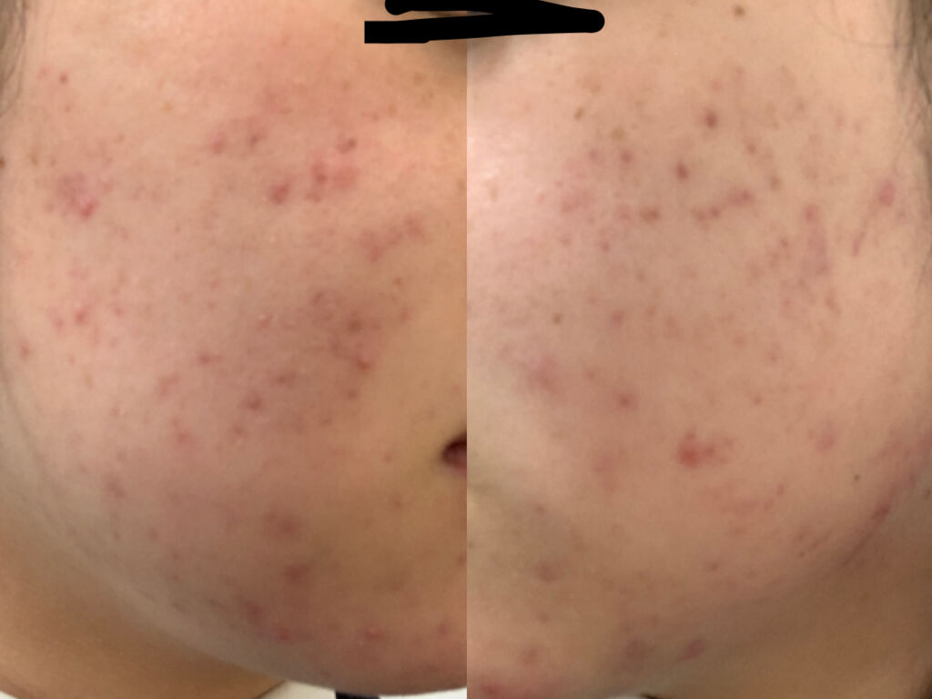 ベピオゲル/マルホ株式会社/その他を使ったクチコミ（1枚目）