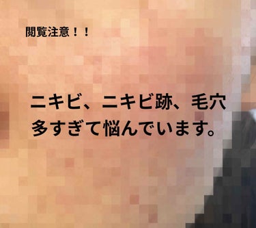 ロゼット ロゼット洗顔パスタ アクネクリアのクチコミ「肌綺麗になりたいです。。
髪の毛や手、布団などが顔にあたるとすぐにニキビが出来てしまう超敏感肌.....」（1枚目）