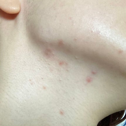 ペアアクネクリームW(医薬品)/ペア/その他を使ったクチコミ(3枚目)