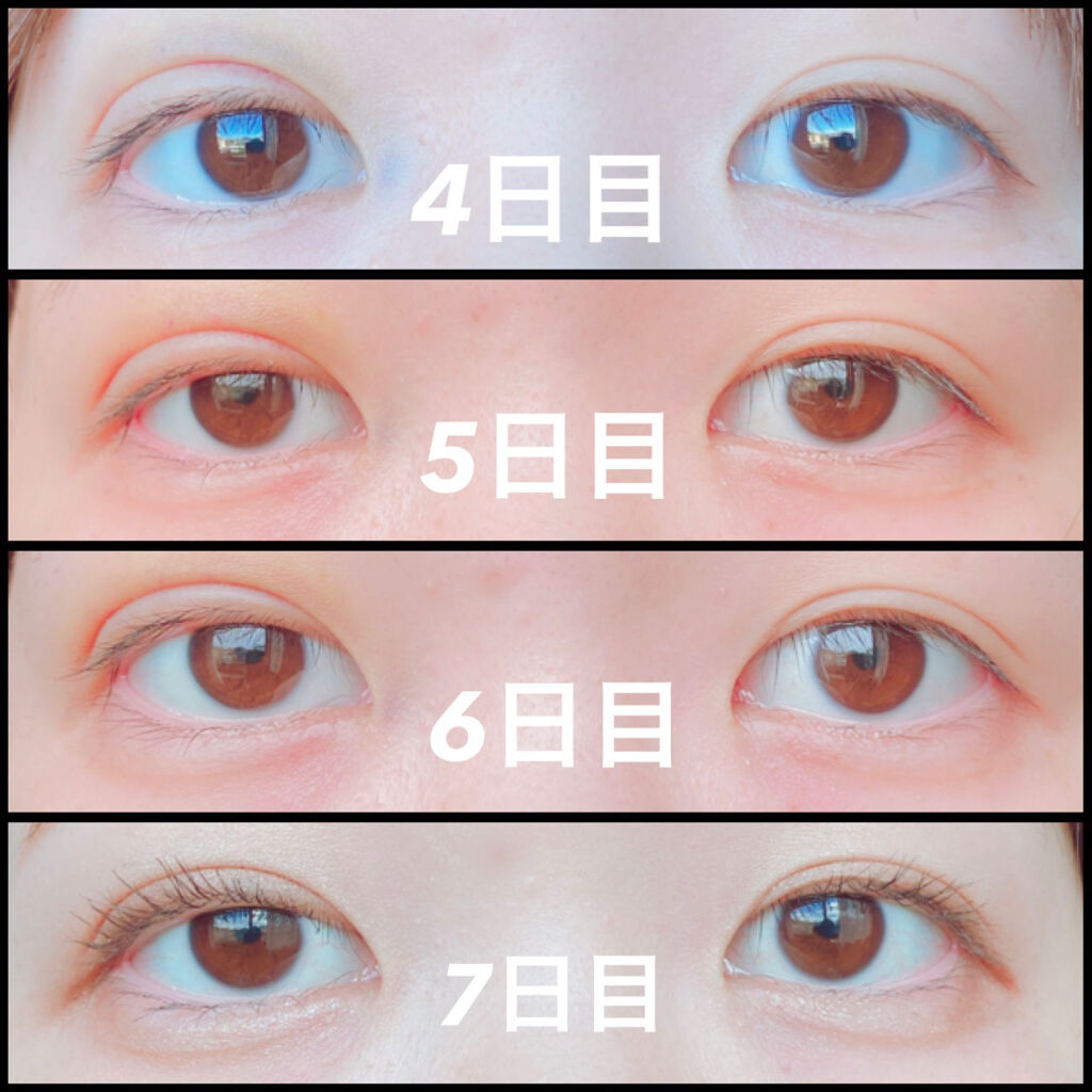 二重整形/その他を使ったクチコミ（3枚目）