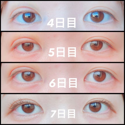 二重整形/その他を使ったクチコミ(3枚目)