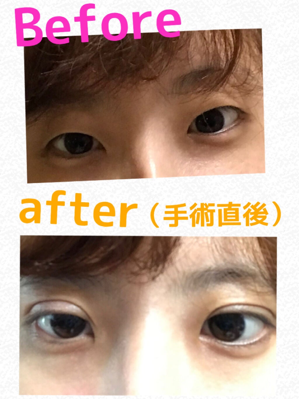 しおり on LIPS 「二重整形について〜私は2年前に二重整形、埋没をしました学生の頃..」(2枚目)